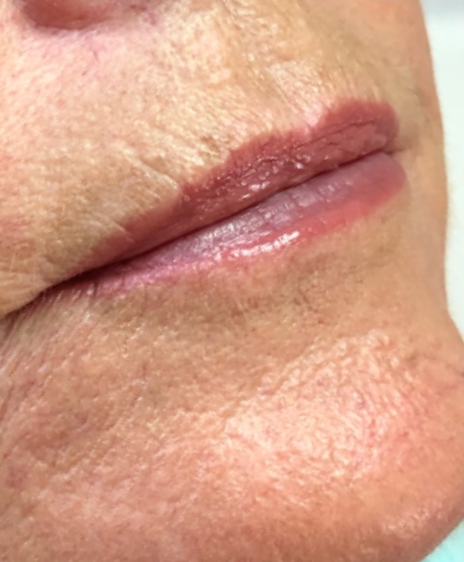 Lip Filler After