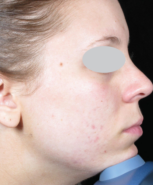 Acne Scar ResurFX treatment on face after photo