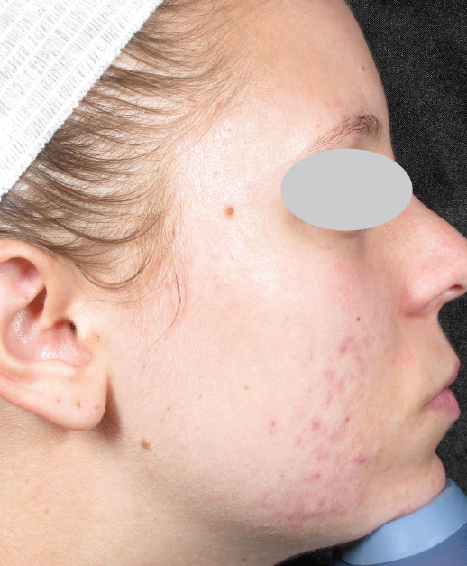 Acne Scar ResurFX treatment on face before photo