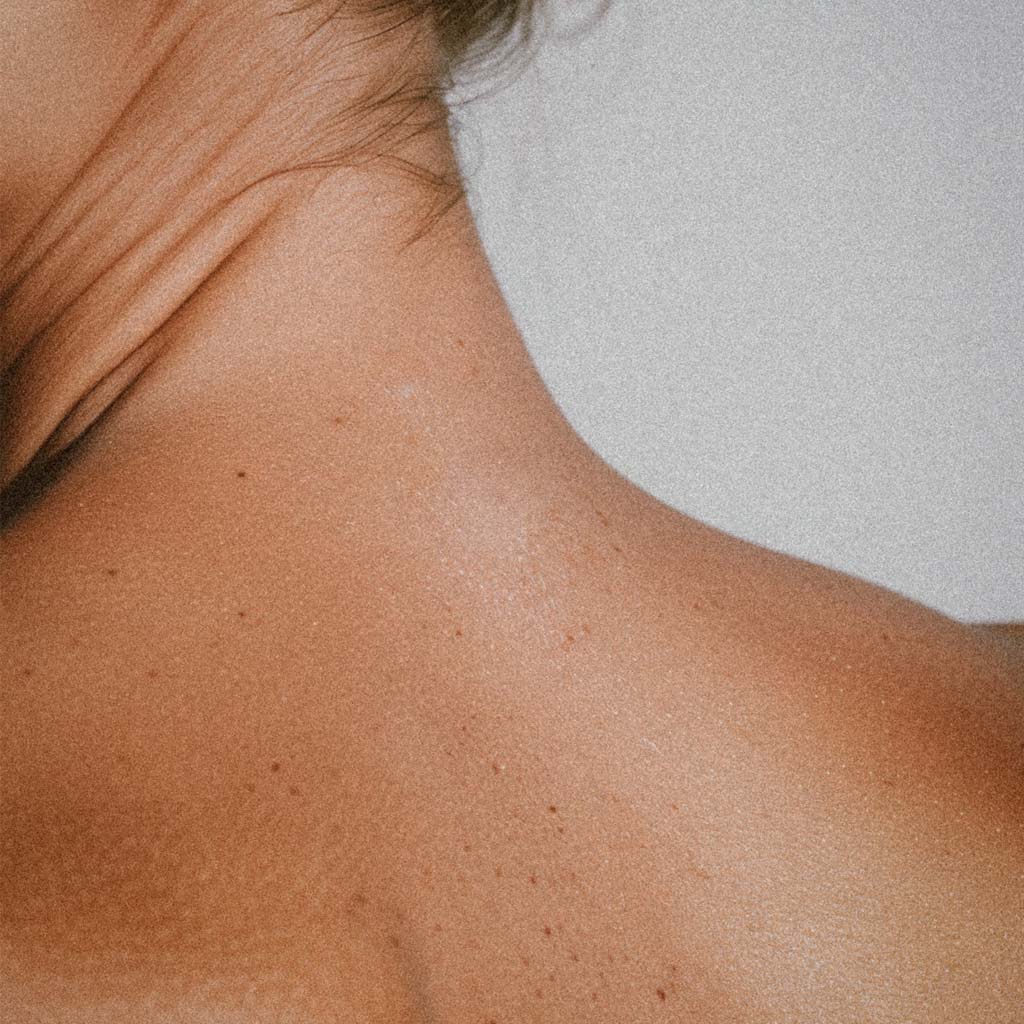 Treatment for Redness sun damage and pigmentation in Lancaster