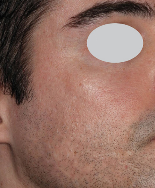 Scarred Face ResurFX treatment after photo
