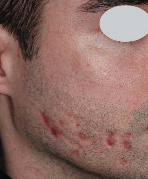 Scarred Face ResurFX treatment before photo