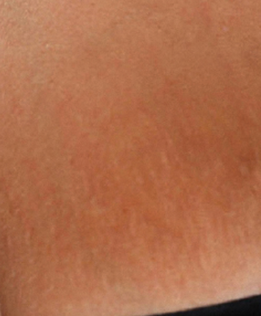 Stretch marks after ResurFX Treatment