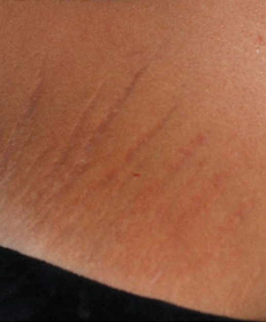 Stretch marks before ResurFX Treatment