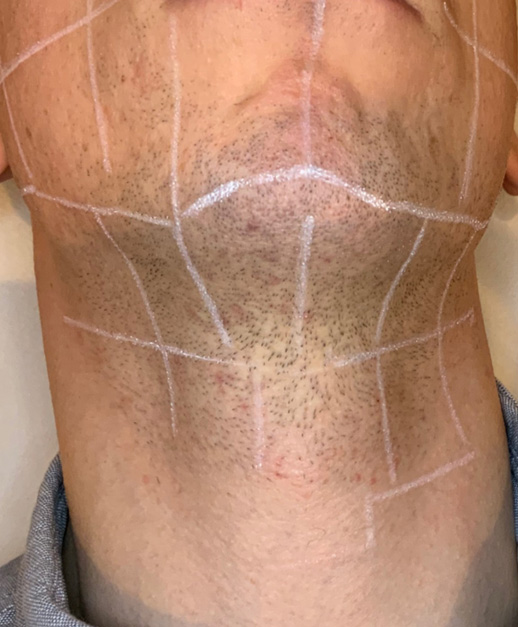 After photo mens facial laser hair removal