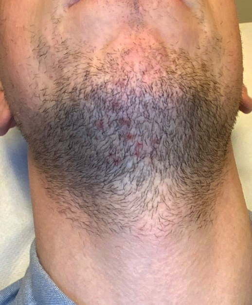 Before image of mens facial laser hair removal