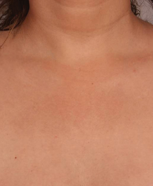 IPL Body Pigmentation Treatment After Photo