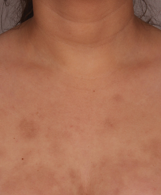 IPL Body Pigmentation Treatment Before Photo