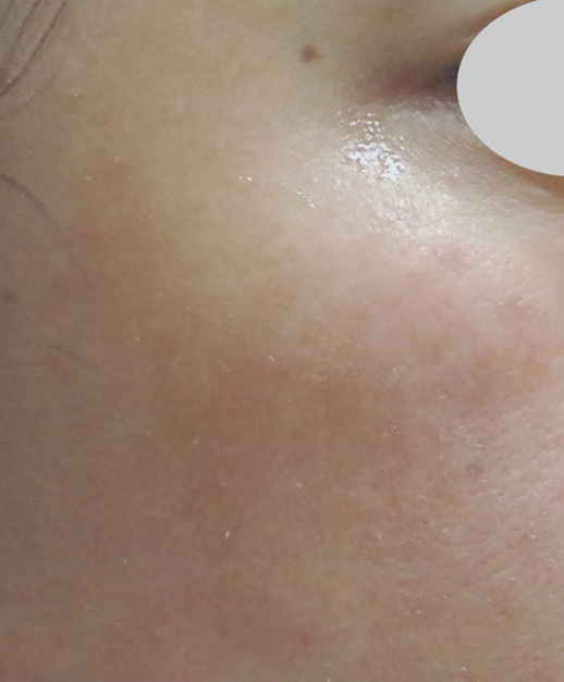 IPL Pigmentation Treatment After Photo