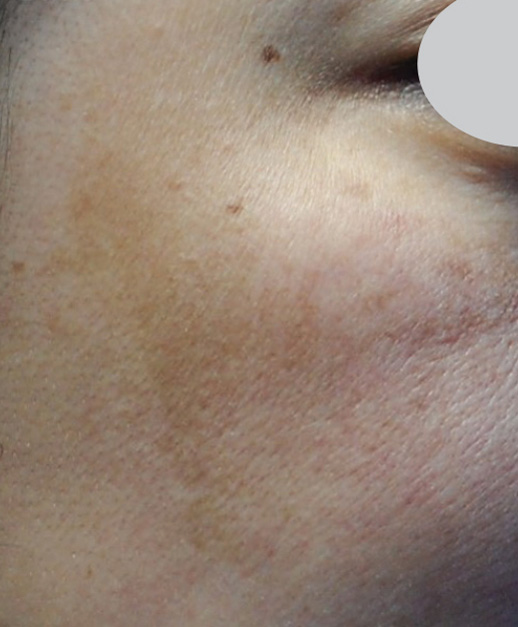 IPL Pigmentation Treatment Before Photo