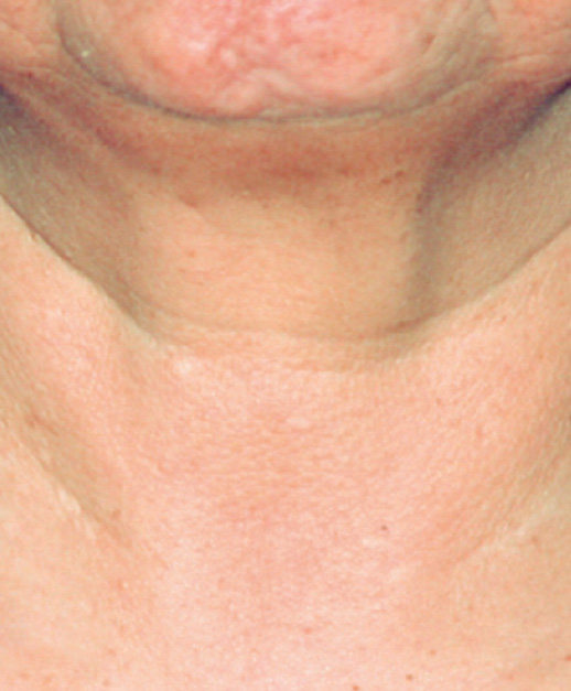 Neck Photofabulous Treatment After