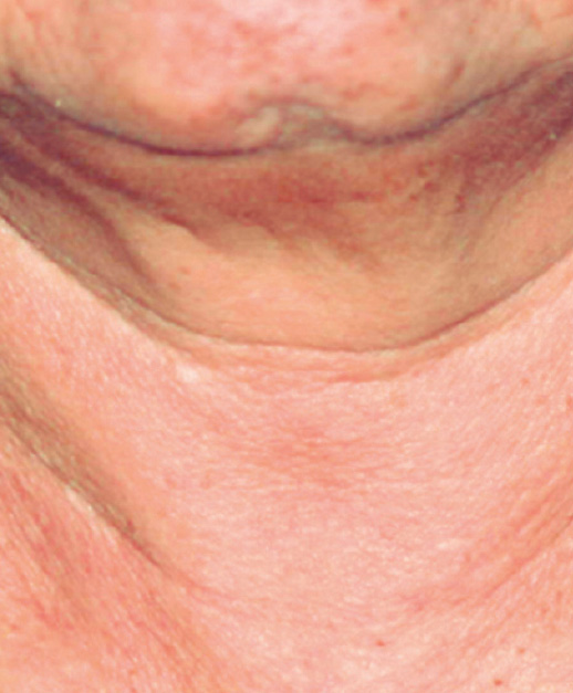 Neck Photofabulous Treatment Before