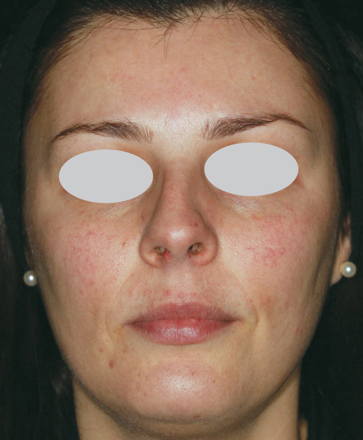 Photofabulous Treatment Before Photo